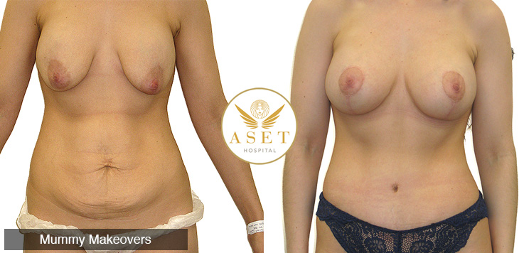UK elite cosmetic surgeons at Aset Hospital and mummy makeovers before and after mummy makeover cosmetic surgery